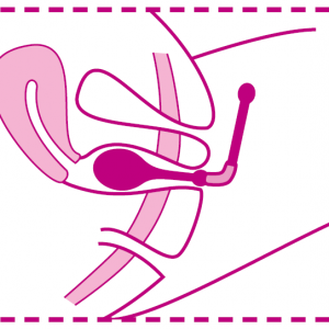 sonde_peritop_position1