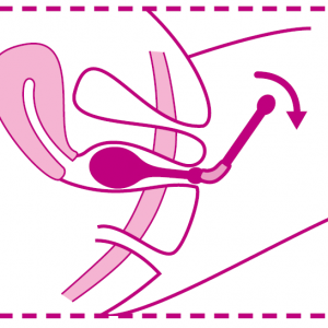 sonde_peritop_position2